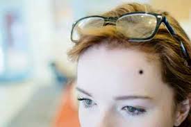 Mole on the Forehead - Mole Meaning